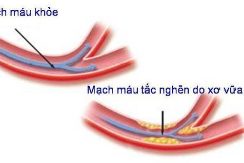 Tại sao cần dự phòng bệnh xơ vữa động mạch ở người trẻ?