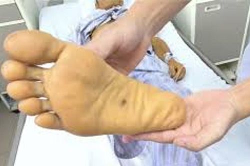 Suy gan, suy thận cấp chỉ vì một vết xước nhỏ