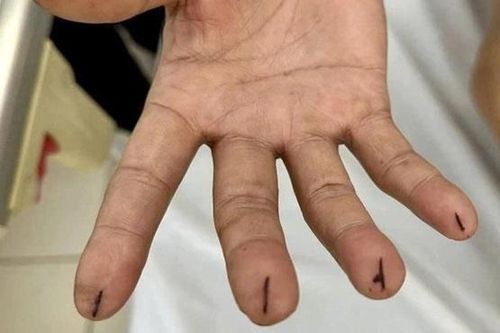 Người đàn ông nhập viện với các đầu ngón tay bị kim chích sâu