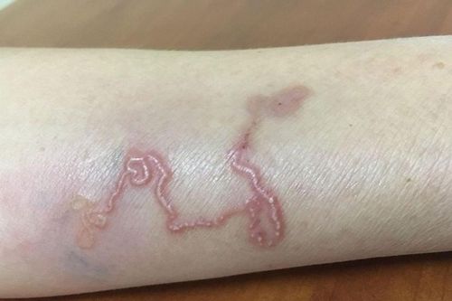 Món khoái khẩu khiến người đàn ông nhiễm cả 2 loại ký sinh trùng