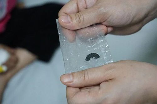 Thông tin ca bệnh: Dị vật bỏ quên-cúc áo