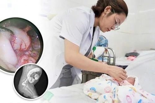 Phẫu thuật phình đại tràng bẩm sinh cho trẻ sơ sinh 30 ngày tuổi nhẹ cân