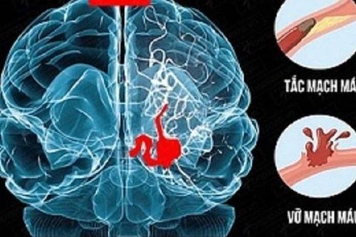 Đột quỵ và 'vết sẹo' vô hình trên não bộ
