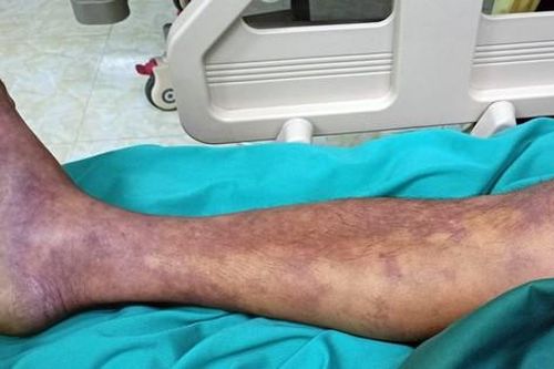 Hà Nội ghi nhận ca tử vong đầu tiên do liên cầu lợn trong năm: Làm sao phòng bệnh hiệu quả?