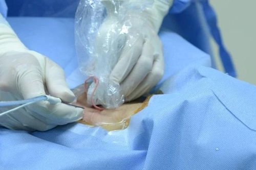 Bước đột phá điều trị hạch cổ tái phát sau mổ ung thư tuyến giáp bằng kỹ thuật đốt sóng cao tần