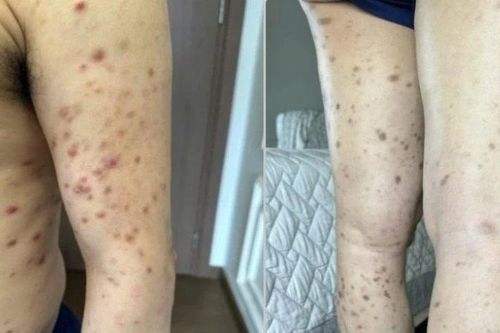 Nguy cơ mắc bệnh hiếm từ tổn thương da dai dẳng