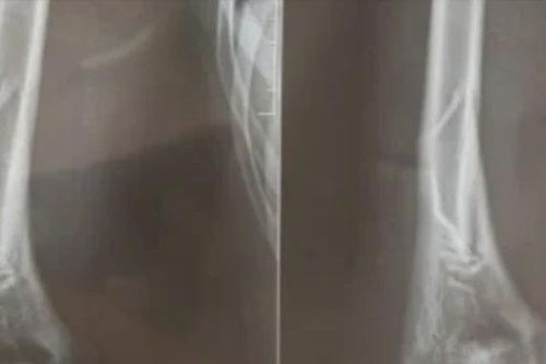 Chơi trò 'vật tay', nam thanh niên 18 tuổi bị gãy xương cánh tay phải