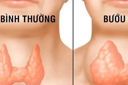 Thiếu i-ốt gây hại như thế nào?