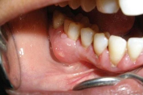 Áp-xe răng: 'Quả bom nổ chậm' nguy hiểm