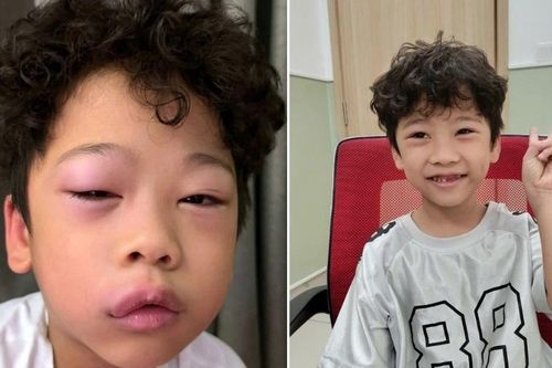 30 phút chơi slime, bé trai bị phù mạch nghiêm trọng