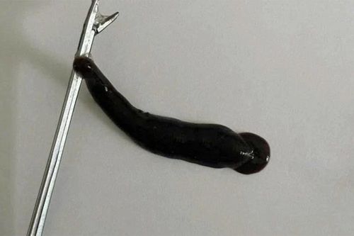 Gắp ra con đỉa sống ký sinh trong mũi bệnh nhi ở Quảng Trị