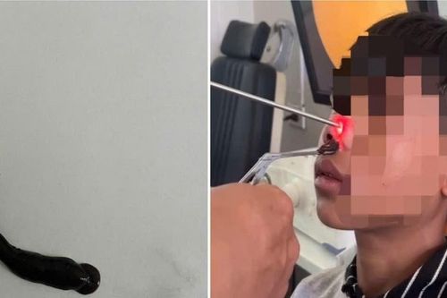 Lỗ mũi thiếu niên liên tục rỉ máu, bác sĩ khám chỉ ra điều bất ngờ