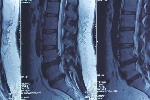 Cô gái 23 tuổi suýt liệt chân vì thoát vị đĩa đệm