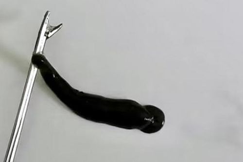 Đỉa suối 4cm nằm trong mũi một thiếu niên