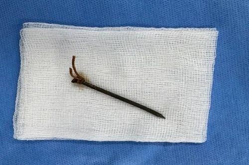 Gặp tai nạn hi hữu, người đàn ông bị đinh sắt cắm sâu vào giữa cổ