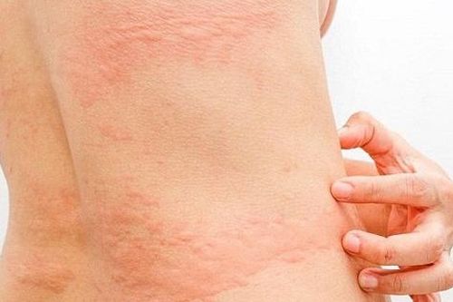 Đi mưa dầm, về mắc nấm da: Những vùng dễ bị 'tấn công' mà ai cũng bỏ qua