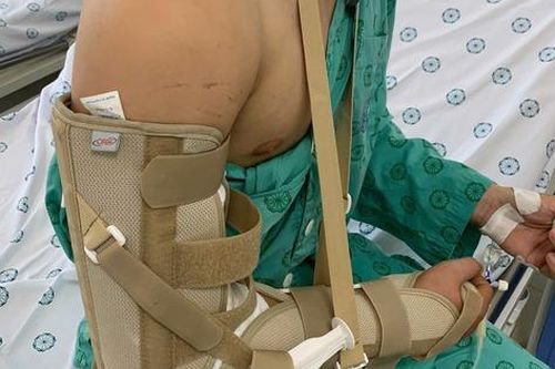 Chơi vật tay, nam thanh niên 18 tuổi bị gãy xương cánh tay