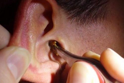 Rùng mình phát hiện thủ phạm khiến tai bé trai đau dữ dội