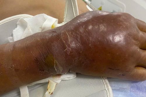 Chủ quan với vết thương ở tay, người đàn ông ngưng thở tím tái do uốn ván