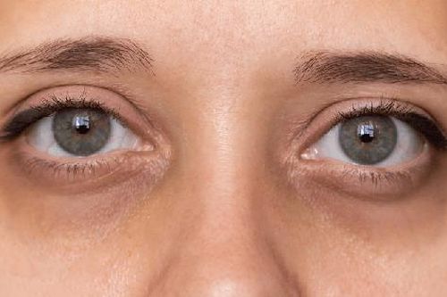 5 dấu hiệu ở mắt cảnh báo nguy cơ đột quỵ mà nhiều người vẫn chưa biết