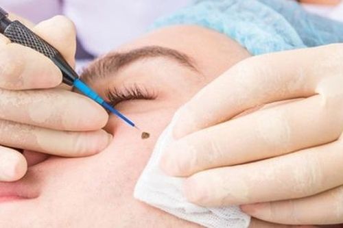 Đốt nốt ruồi nhiều lần, người đàn ông bất ngờ nhận tin dữ