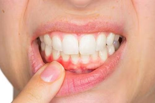 5 sai lầm 'tai hại' khi đánh răng, 'hủy hoại' nướu (lợi) mỗi ngày
