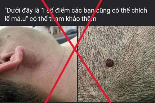 Bác sĩ cảnh báo về các sai lầm trong sơ cứu bệnh nhân đột quỵ