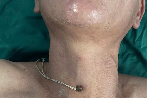 Cứu sống bệnh nhân bị đinh thép xuyên khí quản