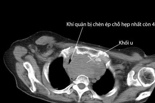 Suýt mất mạng vì chủ quan với bướu giáp lành tính
