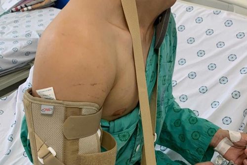 Nam thanh niên 18 tuổi gãy xương khi chơi vật tay với bạn