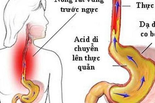 Nuốt nghẹn nghĩ chỉ viêm thực quản, người phụ nữ 54 tuổi ở Hà Nội đi khám phát hiện mắc cùng lúc 6 bệnh