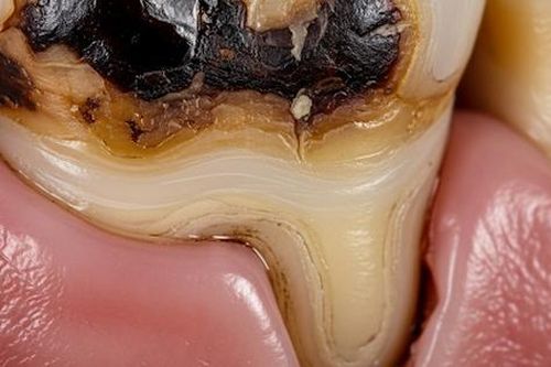 Cảnh báo 'kẻ thù thầm lặng' đang phá hủy răng của nhiều người