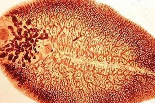 Tưởng đau dạ dày hóa ra nhiễm sán lá gan lớn