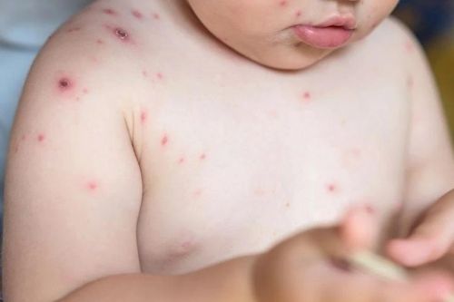 Thủy đậu dễ lây, 85% ca nhiễm từ người trong gia đình