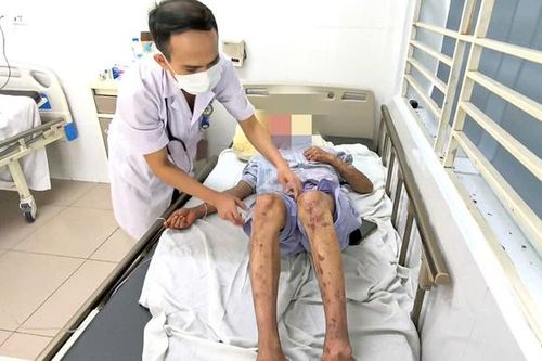 Nguy cơ dị ứng đe dọa sức khỏe người lao động từ silicon trong xây dựng
