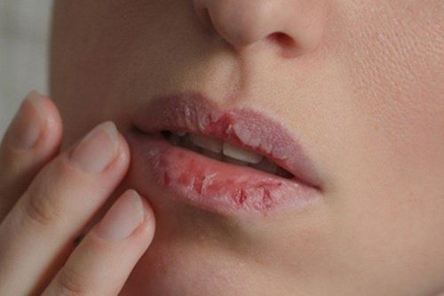 Cô gái trẻ khổ sở vì môi khô nứt toác, rỉ máu suốt 6 tháng, đi khám bác sĩ chỉ ra thủ phạm ít ai ngờ