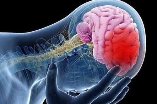 Đột quỵ: 'Sát thủ thầm lặng' khiến gần 50% người mắc không qua khỏi
