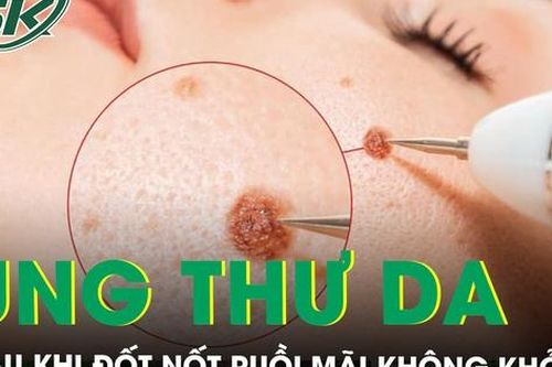 Đốt nốt ruồi ở nước ngoài mãi không khỏi, về Việt Nam phát hiện mắc ung thư