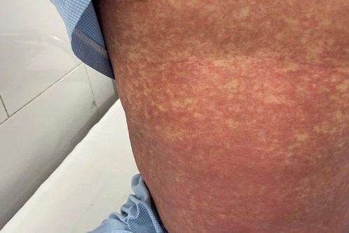Biến chứng nghiêm trọng vì tự ý dùng thuốc chống viêm Phenylbutazone đã bị cấm tại Việt Nam