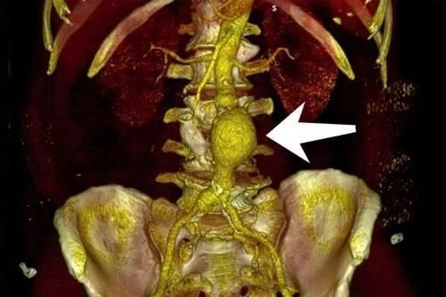 Nhiều người nhập viện vì phình động mạch chủ, căn bệnh nguy hiểm dễ tử vong