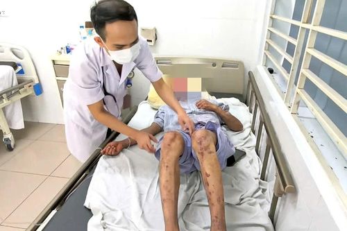 Mù tạm thời, bỏng nặng do tiếp xúc silicon chống dột