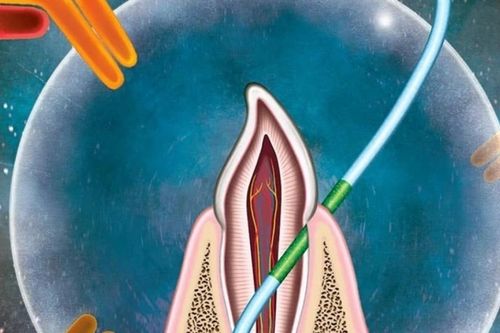 Một loại vaccine mới không cần kim tiêm, có tác dụng như chỉ nha khoa, cần nghiên cứu thêm