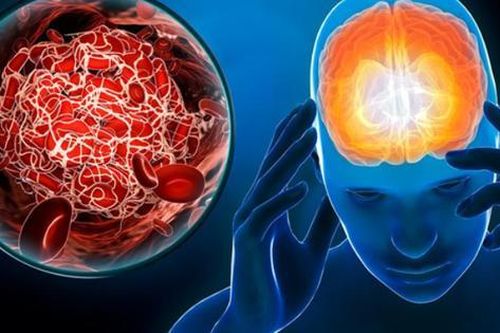 Đột quỵ và hội chứng 'ngồi lâu': Nguy hiểm hơn bạn tưởng