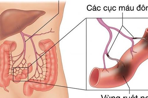 Phát hiện 'thủ phạm' gây tắc tĩnh mạch sau 7 lần mổ hoại tử ruột