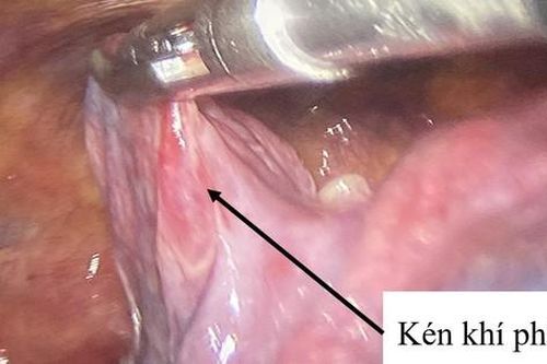 Đột ngột khó thở cảnh giác với kén khí phổi