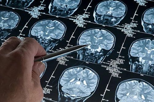 7 thói quen giúp giảm nguy cơ mắc Alzheimer - ngay cả khi bạn mang gene rủi ro