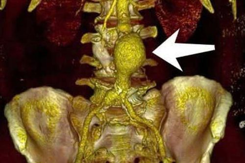 Cảnh giác với phình động mạch chủ khi bệnh không có biểu hiện rõ ràng
