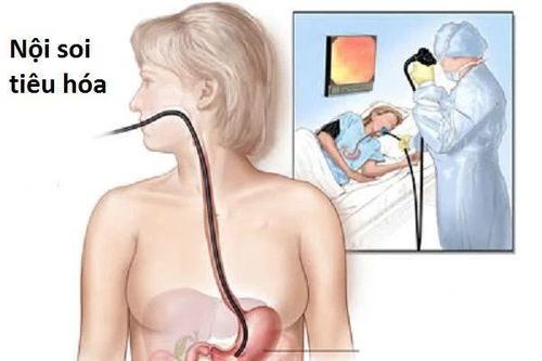 Dấu hiệu cần nội soi tiêu hóa để phát hiện sớm bệnh lý