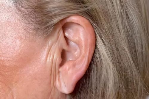 Nếp gấp ở dái tai có thể dự đoán nguy cơ đau tim, tiểu đường và đột quỵ?