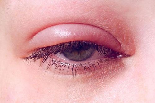 Viêm bờ mi mắt cần chăm sóc như thế nào?
